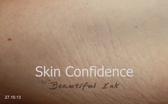 Stretch Marks before treatment